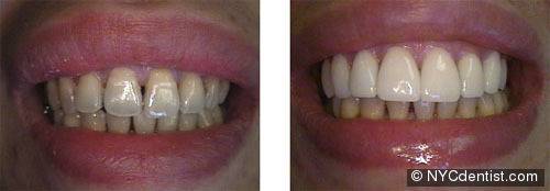 Porcelain veneers smile makeover from NYC dentist